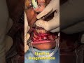 Entire 3D Bony Permanent Jaw Line Augmentation From Angle to chin Surgery by Dr sunil Richardson