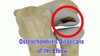 팔꿈치 박리성 골연골염: 원인과 치료 Elbow Osteochondritis Dissecans: Causes and Treatment