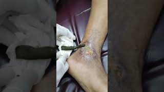 Leech Therapy for vericose vien