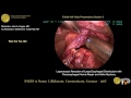 Laparoscopic resection of large esophageal diverticulum with PEHR & Heller myotomy