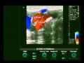 Carotid & Vertebral Arteries Ultrasonic Evaluation