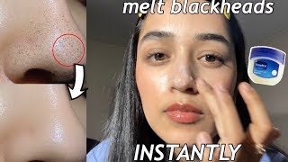 I removed my blackheads INSTANTLY w/ VASELINE + OIL! | How to get rid of blackheads