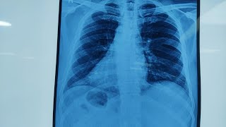 Dextrocardia Situs Inversus and Angioplasty