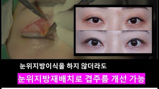 비씨아이의 눈위지방재배치만으로 겹주름, 꺼진눈 해결한 실제 수술 사례