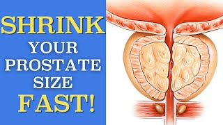 How to Avoid a Catheter with an Enlarged Prostate Gland | 3 Ways to Reduce an Enlarged Prostate