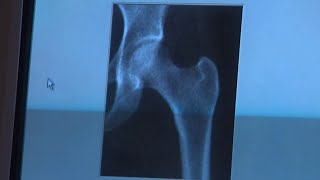 New screening guidelines for osteoporosis