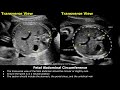 How To Measure Fetal Abdominal Circumference (AC) On Ultrasound | Fetal Biometry | Obstetric USG