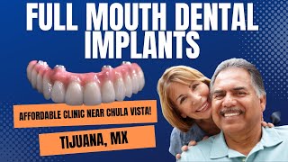 Affordable All On 4 Dental Implants Near Chula Vista: $5,499 - (858) 544-3900 - Best Dental Implants