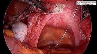 Total Laparoscopic Hysterectomy by Myoma Screw Without Uterine Manipulator