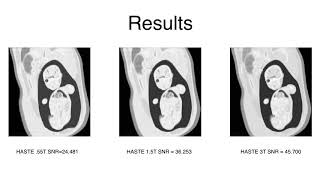 EE-591 Final: Simulation Study of Low-Field Real-Time Fetal MRI