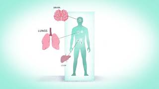 ASMD Facts Chapter 1: What is ASMD and What Causes It?