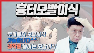 흉터모발이식 / 두피흉터 / 화상흉터모발이식 /성형수술흉터 모발이식 루트모발이식