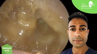 1,173 - Bursting Eardrum after Discharge \u0026 Ear Wax Removal