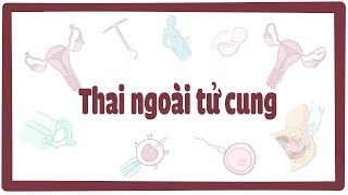 Thai ngoài tử cung