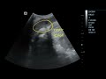 placental surface cysts ultrasound case