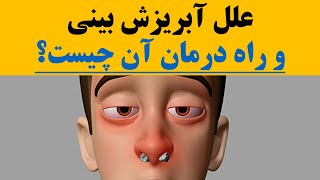 علل آبریزش بینی  و راه درمان آن چیست؟