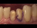 Case of the Week: A New Smile: Restoring the Anterior