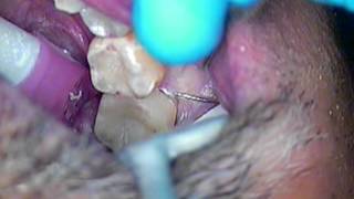 5. All Ceramic Crown Preparation - Tooth Number 31 - Dr. Gerard Cuomo