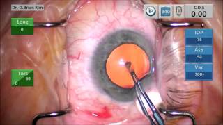 Double Chop: Efficient Modified Phaco Chop Technique, Small Pupil Cases