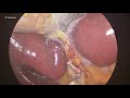 25082020 laparoscopic cholecystectomy for gallbladder stones 1259