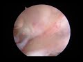 Bursoscopic Ultrasound Guided Ossicle Resection for Osgood–Schlatter Disease