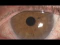 descemetorhexis without endothelial keratoplasty dwek or descemet stripping only dso for fuchs