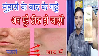 how to remove acne scar completely, best medicine to remove acne scar, acne scar kaise thik kare