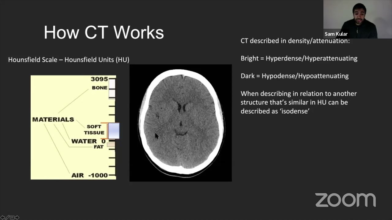 Ct Head Interpretation Youtube
