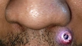 plucking Facial Huge HAIR Remove ASMR No.022