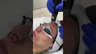 PicoSure Laser Treatment for dark spots #shorts #satisfying #antiaging #lasertreatment #picosure