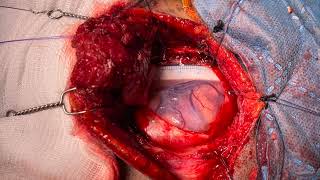 Epilepsy surgery - Anteromedial Temporal Lobectomy and Amygdalohippocampectomy