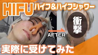 【美容医療】HIFU/ハイフ\u0026ハイフシャワー、えりりんが受けてみた！