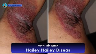 Hailey Hailey Disease treatment | long term groin infection/  काछ लगना  / Dr. Uttam Kumar Lenka