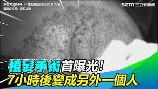 植髮手術首曝光　7小時之後他變成另外一個人｜三立新聞網 SETN.com