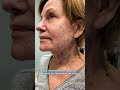 profound rf for skin tightening of face and body explained and demonstrated.