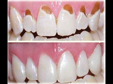 Tooth enamel loss & How to repair tooth enamel? Tooth enamel loss & How to repair tooth enamel?