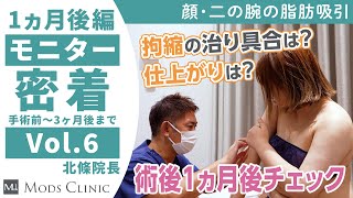 【モニター完全密着】気になる拘縮の様子は？「術後1ヶ月検診」編（第6話）/カウンセリング〜手術後3ヶ月の経過まで全て公開！/北條誠至 院長｜Mods Clinic モッズクリニック（脂肪吸引・注入）