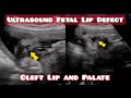 Ultrasound Showing Fetal  Lip Defect , Normal Lips vs Cleft Lip and Palate.