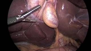 Gallbladder Clinical Case Using the Levita Magnetic Surgical System