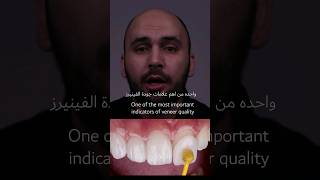 اهم علامة لجودة فينيرز الأسنان #dentist #abudhabi