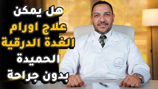 هل يمكن علاج اورام الغدة الدرقية الحميدة بدون جراحة