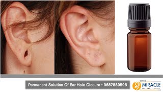 Earlobe / Hole Repair By Ear Pasting lotion / Glue - Call -  9687889595