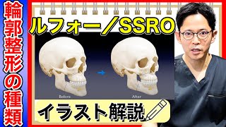 ルフォー／SSRO解説【輪郭整形の種類】