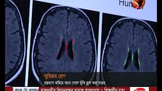 বিশ্বে স্মৃতিভ্রম রোগে ভুগছেন ৫ কোটি মানুষ - CHANNEL 24 YOUTUBE