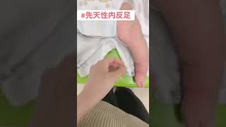 【らむゆあちゃんねる】先天性内反足のらむ#shorts #先天性内反足 #内反足