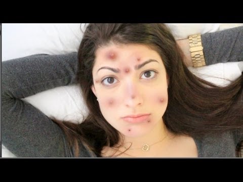 How to Get Rid of Acne Overnight! (Guaranteed less acne) How to Get Rid of Acne Overnight! (Guaranteed less acne)