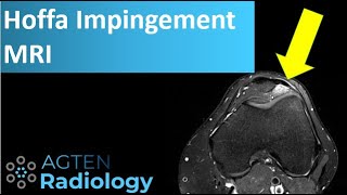 Hoffa Impingement Syndrome on MRI