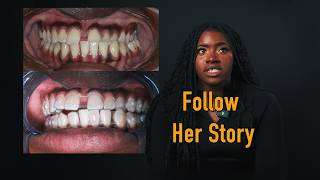 Finally Getting Invisalign After Years of Hiding My Teeth