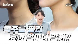 목 주름 필러 실제 유지 기간 (1년 경과)