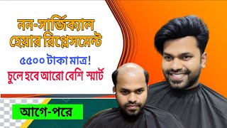 মাত্র ৪৯৯৯ টাকায় টাক মাথার স্থায়ী সমাধান 😍 hair replacement in bd